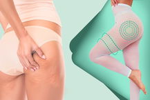 donna che usa collant drenanti per cellulite ostinata