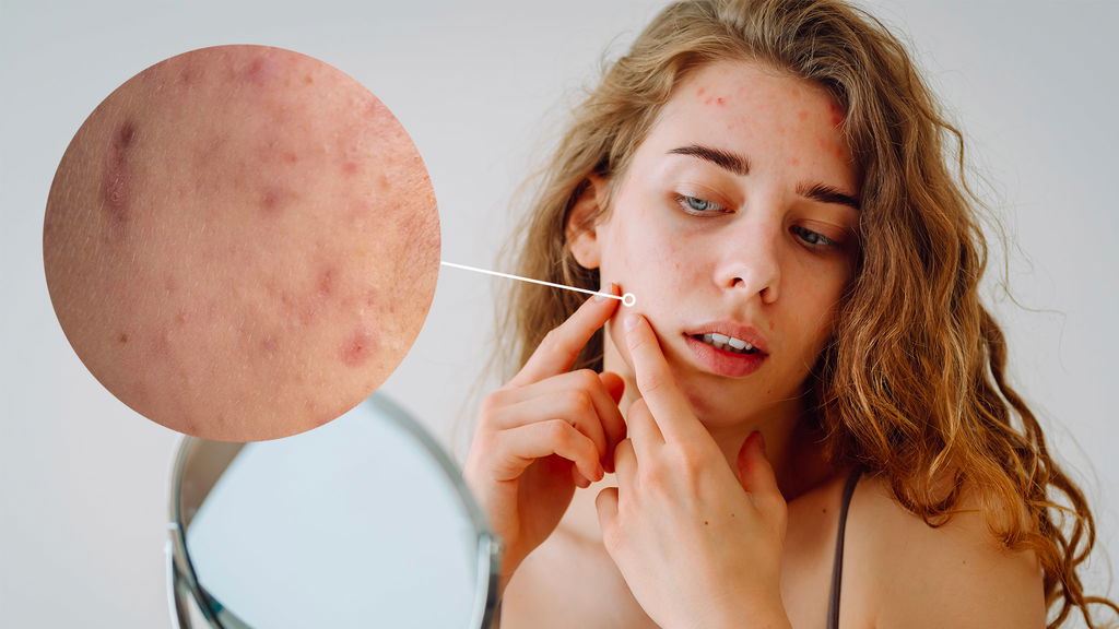 donna con pelle grassa e brufoli che si schiaccia un brufolo