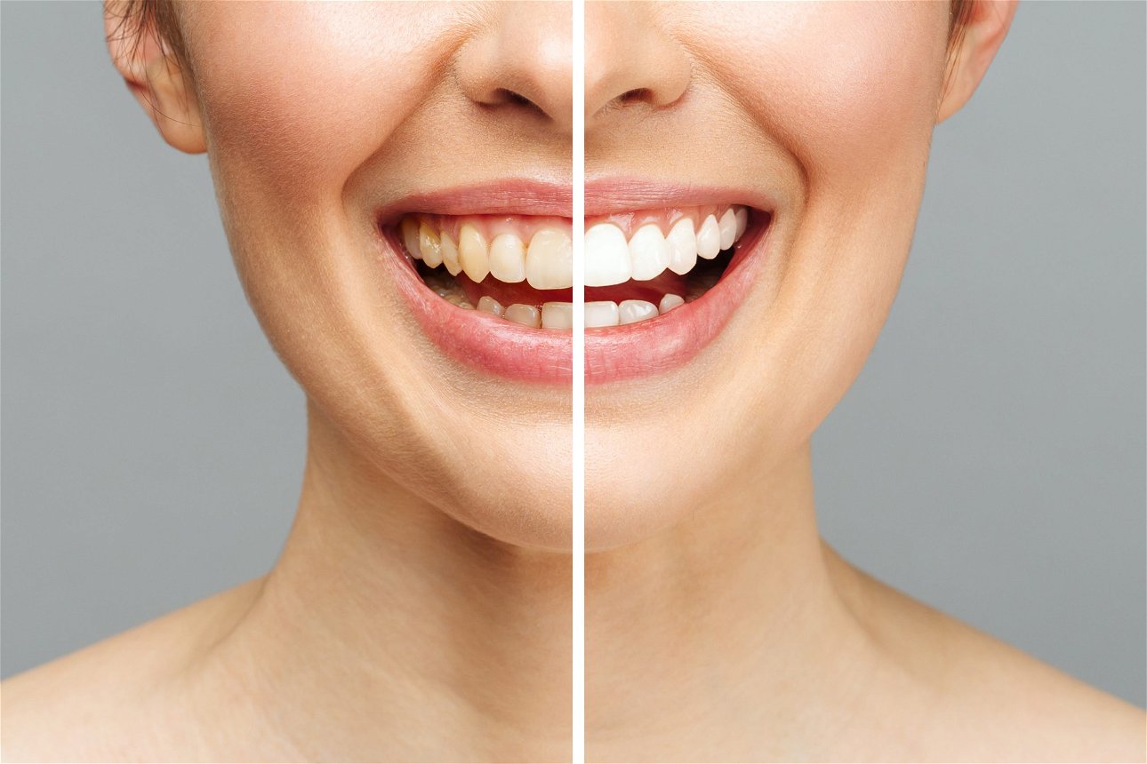 donna sorridente denti sbiancati prima e dopo